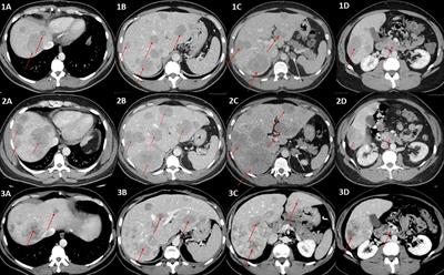 Severe ectopic Cushing syndrome in a transgender man with a metastatic gastrinoma and an adrenal tumor—A case report and review of the literature